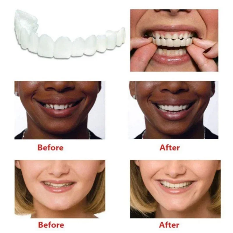 Denture Cover Veneer Snap-on T - Teeth Whitening Session 리뷰 및 가격