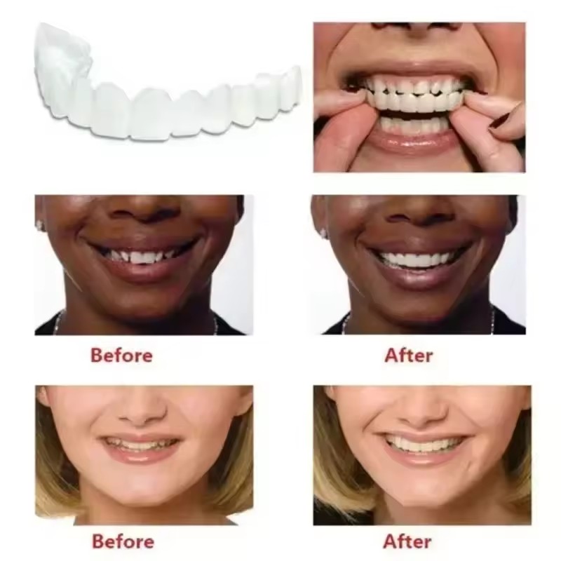 Teeth Veneers Whitening Dentur - Teeth Whitening Session 리뷰 및 가격