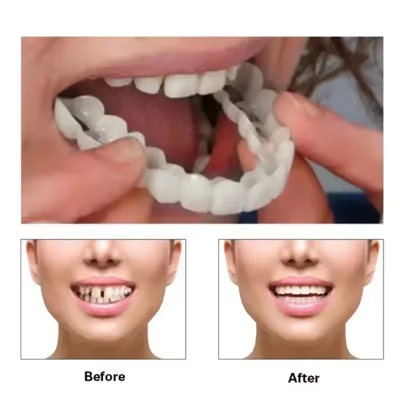 Teeth Veneers Whitening Dentur - Teeth Whitening Session 리뷰 및 가격