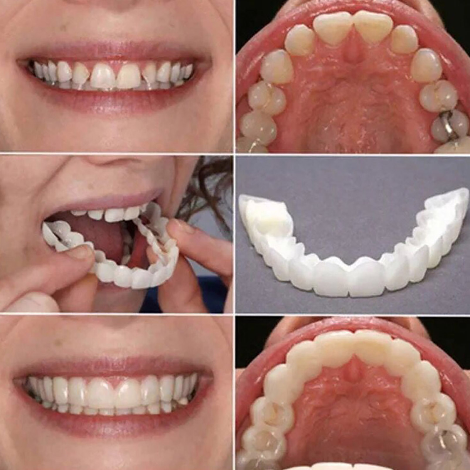 Hot Teeth Veneers Whitening De - Teeth Whitening Session 리뷰 및 가격