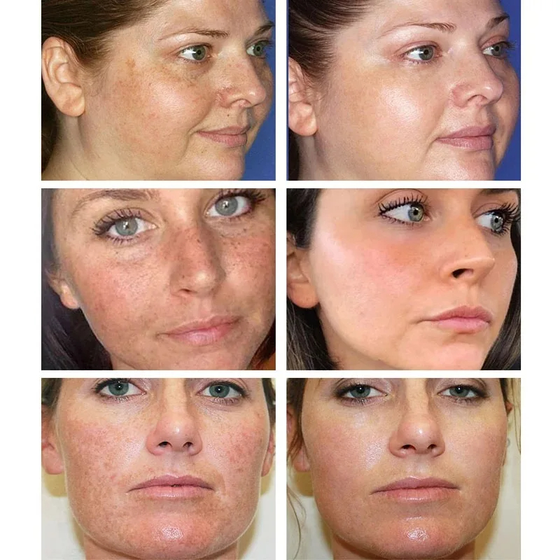 Whitening Freckle Cream Remove - Charcoal Whitening Paste 리뷰 및 가격