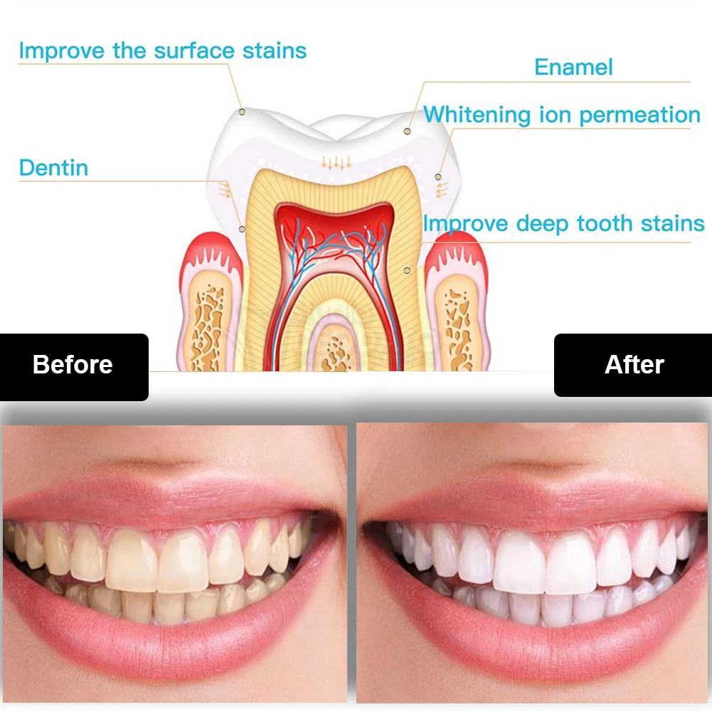 Dental Teeth Whitening Kit Min - Teeth Whitening That Works 리뷰 및 가격